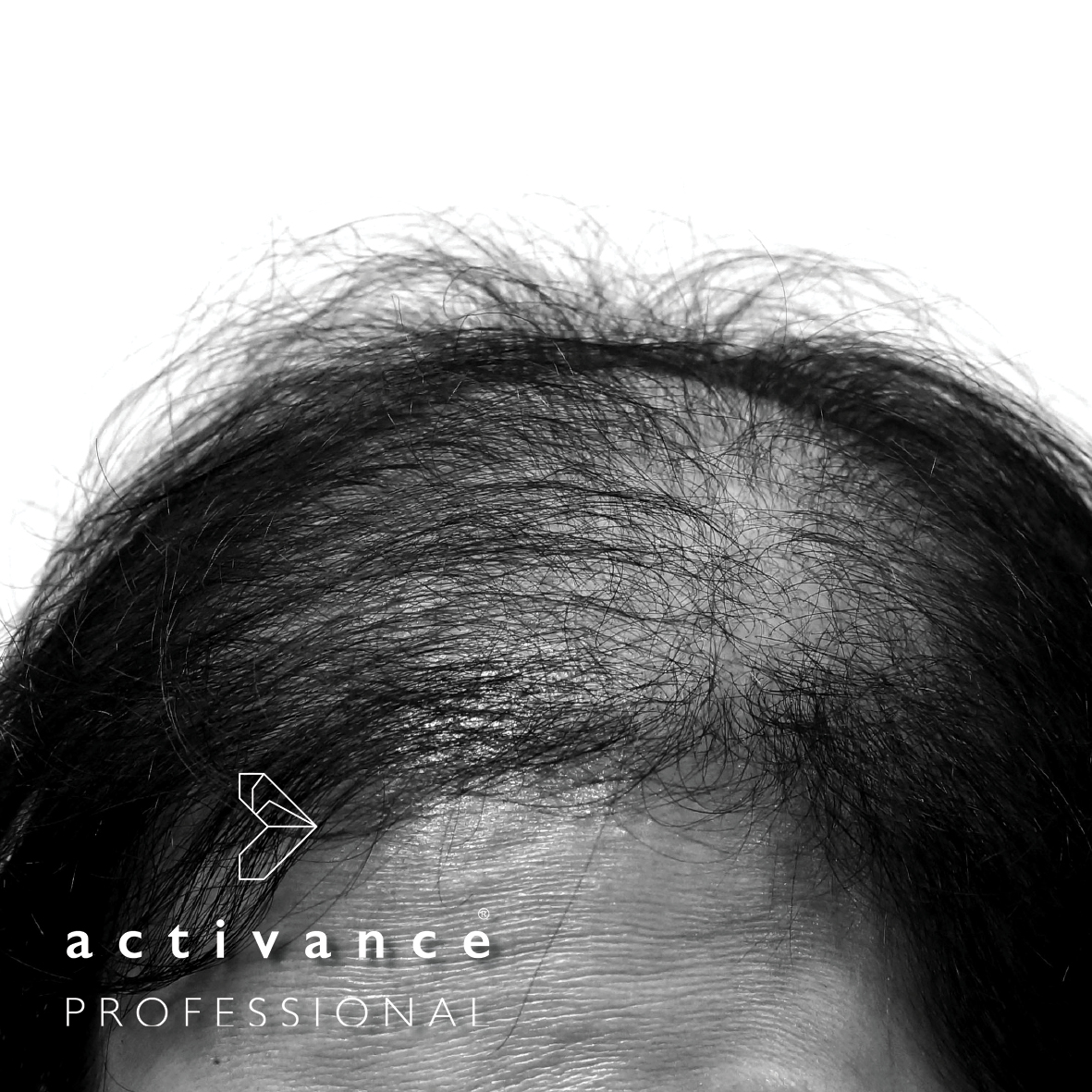 Excessive hair loss can be a distressing condition that affects both men  and women, impacting self-esteem and confidence levels. To tackle… |  Instagram